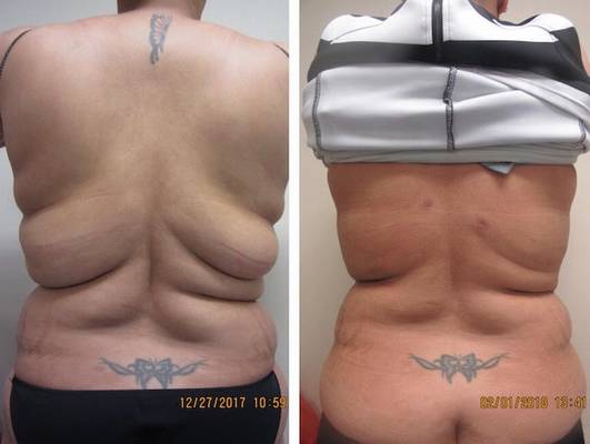 Renuvion/J plasma Drew Varano MD Renuvion/J plasma Drew Varano MD